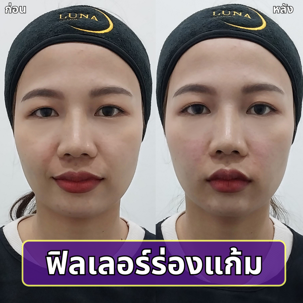 ฟิลเลอร์ร่องแก้ม