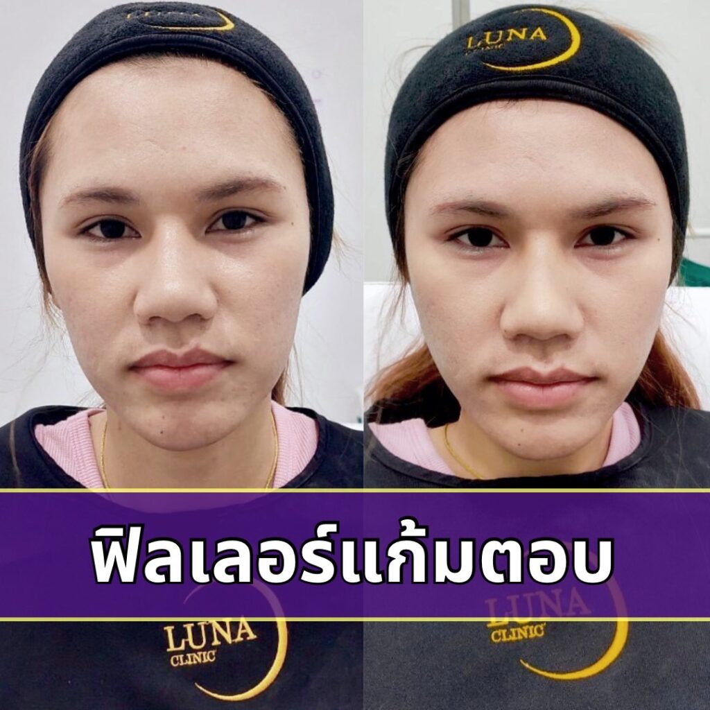 ฟิลเลอร์แก้มตอบ